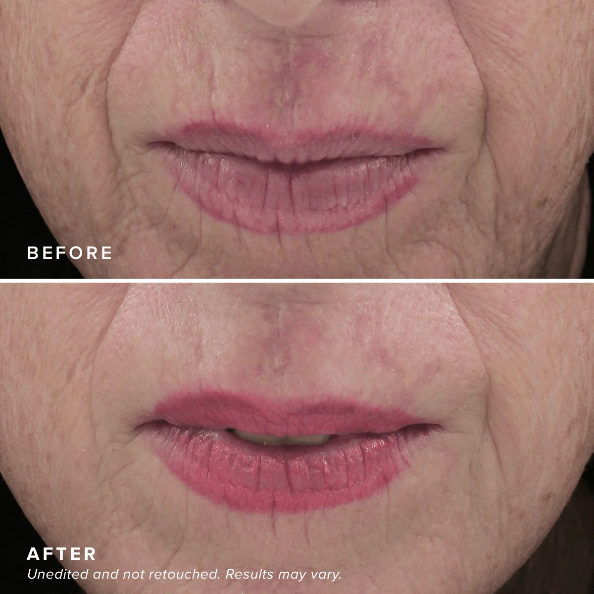 Needle-less® Serum - Image 6