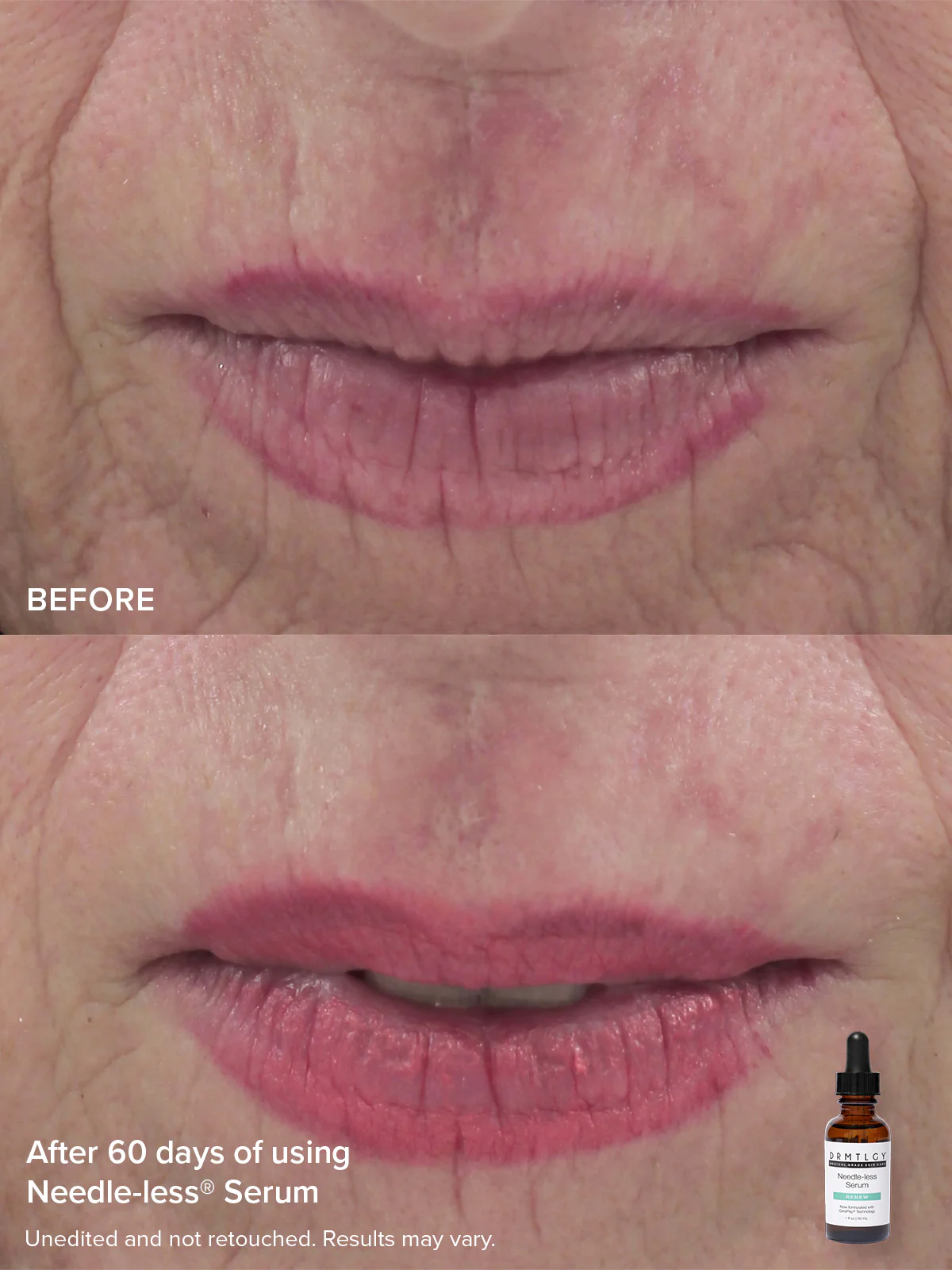 The Needle-less® Duo - Image 6